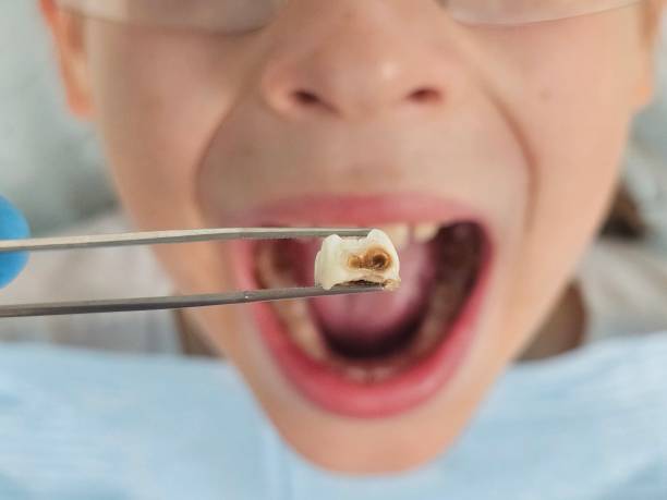 Best Emergency Wisdom Teeth Removal in Fayette, MO